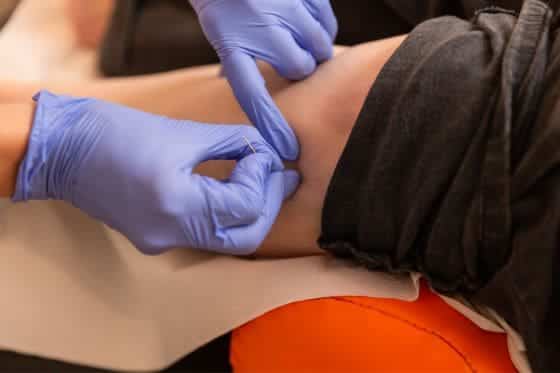 acupuncture vs dry needling