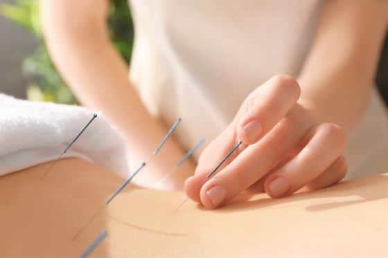 top 10 benefits of acupuncture